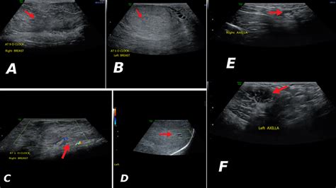 hipertrofia virginal de los senos|Pediatric and adolescent breast hypertrophy